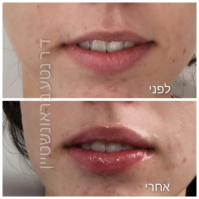 פיסול שפתיים לפני-אחרי | ד"ר נטע בראונשטיין