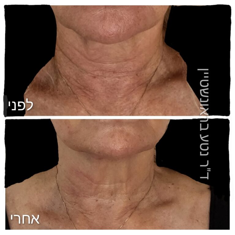 טיפול סקולפטרה משולב למיצוק הצוואר