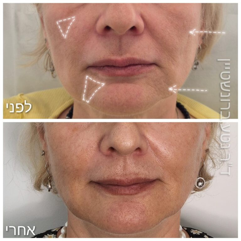 פיסול פנים עם חומצה היאלורונית