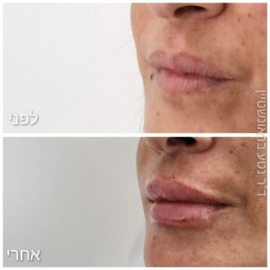 מילוי שפתיים חומצה היאלורונית