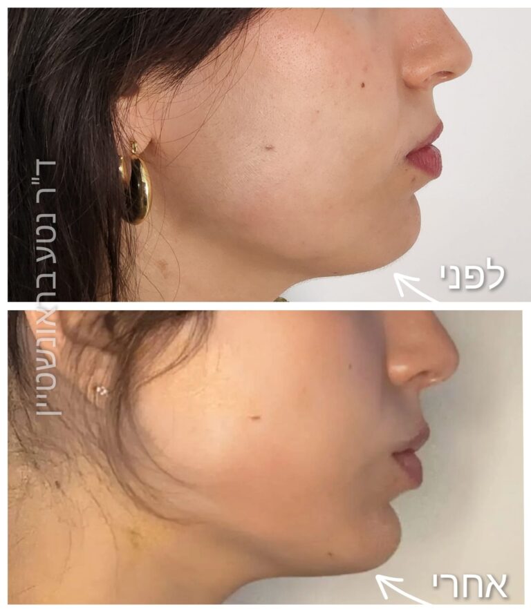 סנטר וקו לסת