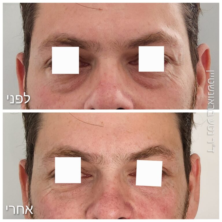 מילוי שקעי עיניים