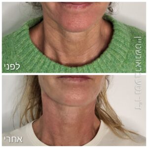 מיצוק צוואר - רדיאס