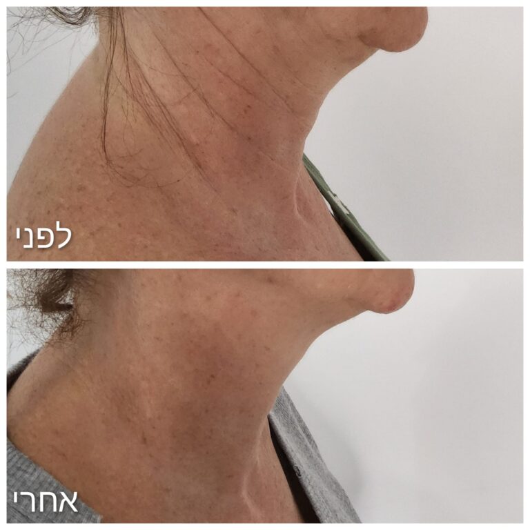 בוטוקס לצוואר, נפרטיטי ליפט ורדיאס היברידי