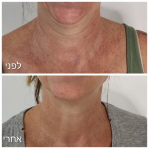 בוטוקס לצוואר, נפרטיטי ליפט ורדיאס היברידי