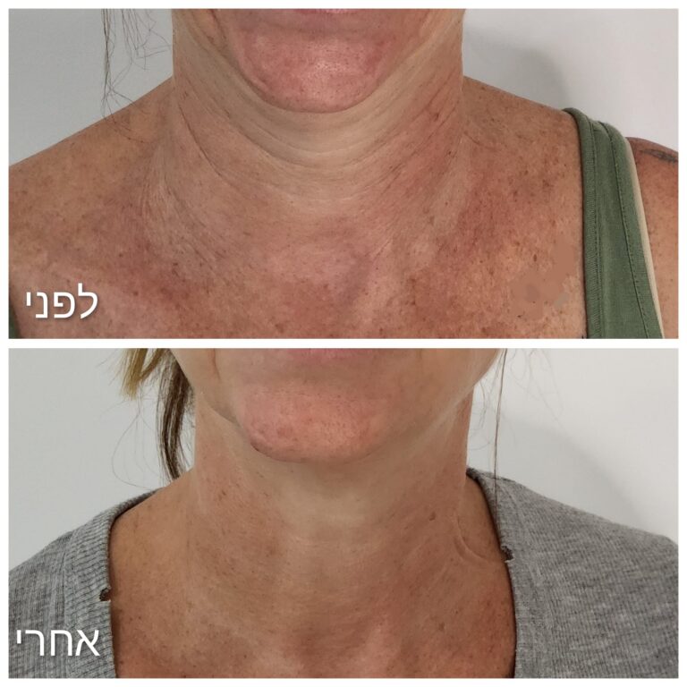 בוטוקס לצוואר, נפרטיטי ליפט ורדיאס היברידי